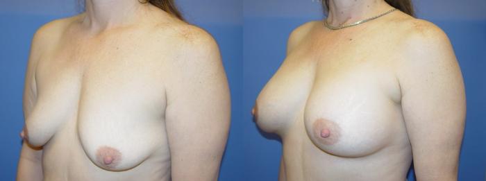 Breast Augmentation Before & After Photo | San Francisco, CA | Kaiser Permanente Cosmetic Services