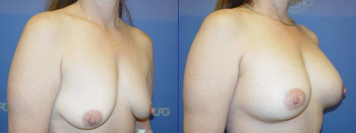 Breast Augmentation Before & After Photo | San Francisco, CA | Kaiser Permanente Cosmetic Services