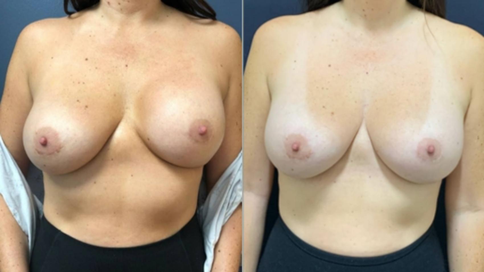 Breast Augmentation Before & After Photo | San Francisco, CA | Kaiser Permanente Cosmetic Services