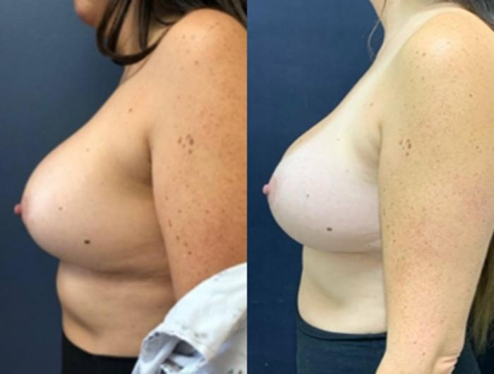 Breast Augmentation Before & After Photo | San Francisco, CA | Kaiser Permanente Cosmetic Services