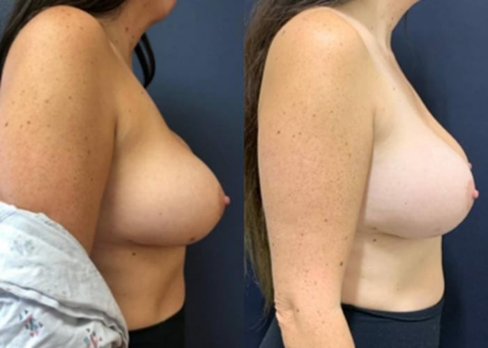 Breast Augmentation Before & After Photo | San Francisco, CA | Kaiser Permanente Cosmetic Services