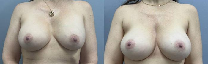 Breast Augmentation Before & After Photo | San Francisco, CA | Kaiser Permanente Cosmetic Services