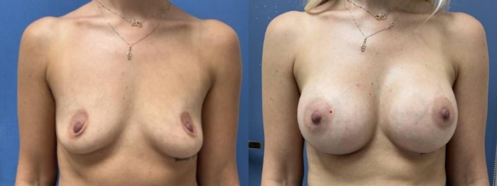 Breast Augmentation Before & After Photo | San Francisco, CA | Kaiser Permanente Cosmetic Services