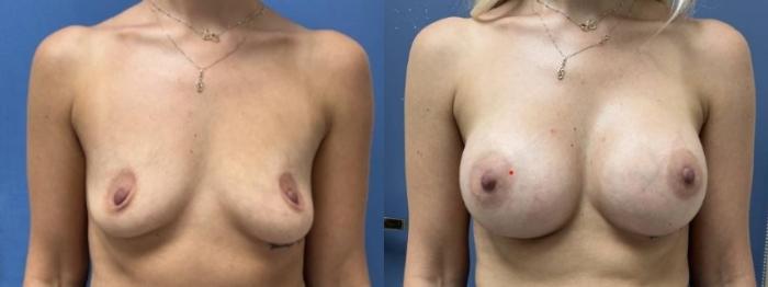 Breast Augmentation Before & After Photo | San Francisco, CA | Kaiser Permanente Cosmetic Services