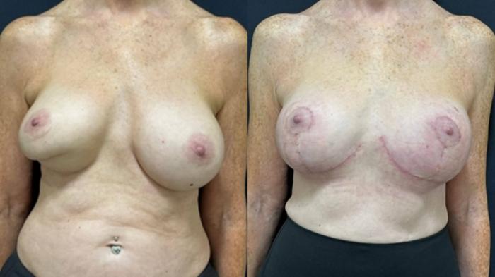 Breast Augmentation Before & After Photo | San Francisco, CA | Kaiser Permanente Cosmetic Services