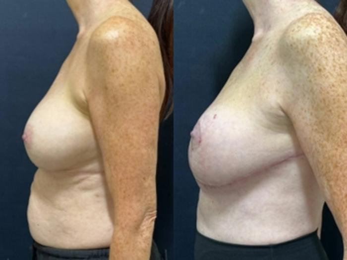 Breast Augmentation Before & After Photo | San Francisco, CA | Kaiser Permanente Cosmetic Services
