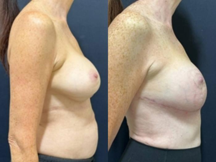 Breast Augmentation Before & After Photo | San Francisco, CA | Kaiser Permanente Cosmetic Services