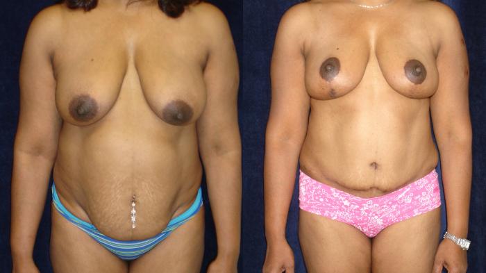 Breast Lift Before & After Photo | San Francisco, CA | Kaiser Permanente Cosmetic Services