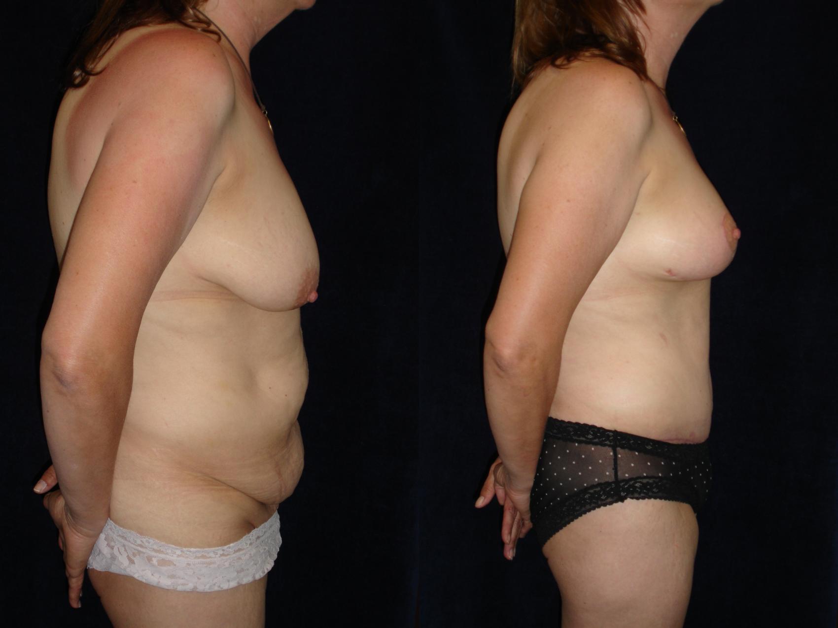 Breast Lift Before & After Photo | San Francisco, CA | Kaiser Permanente Cosmetic Services