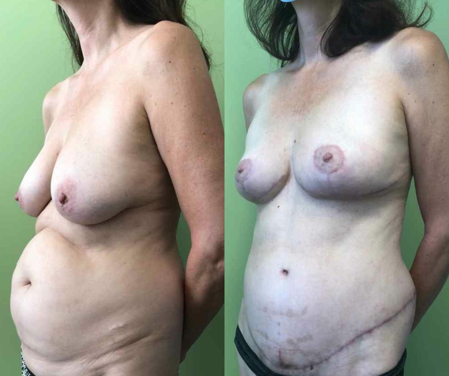 Breast Lift Before & After Photo | San Francisco, CA | Kaiser Permanente Cosmetic Services