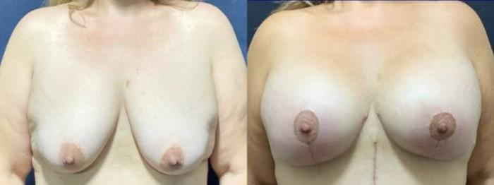 Breast Lift Before & After Photo | San Francisco, CA | Kaiser Permanente Cosmetic Services