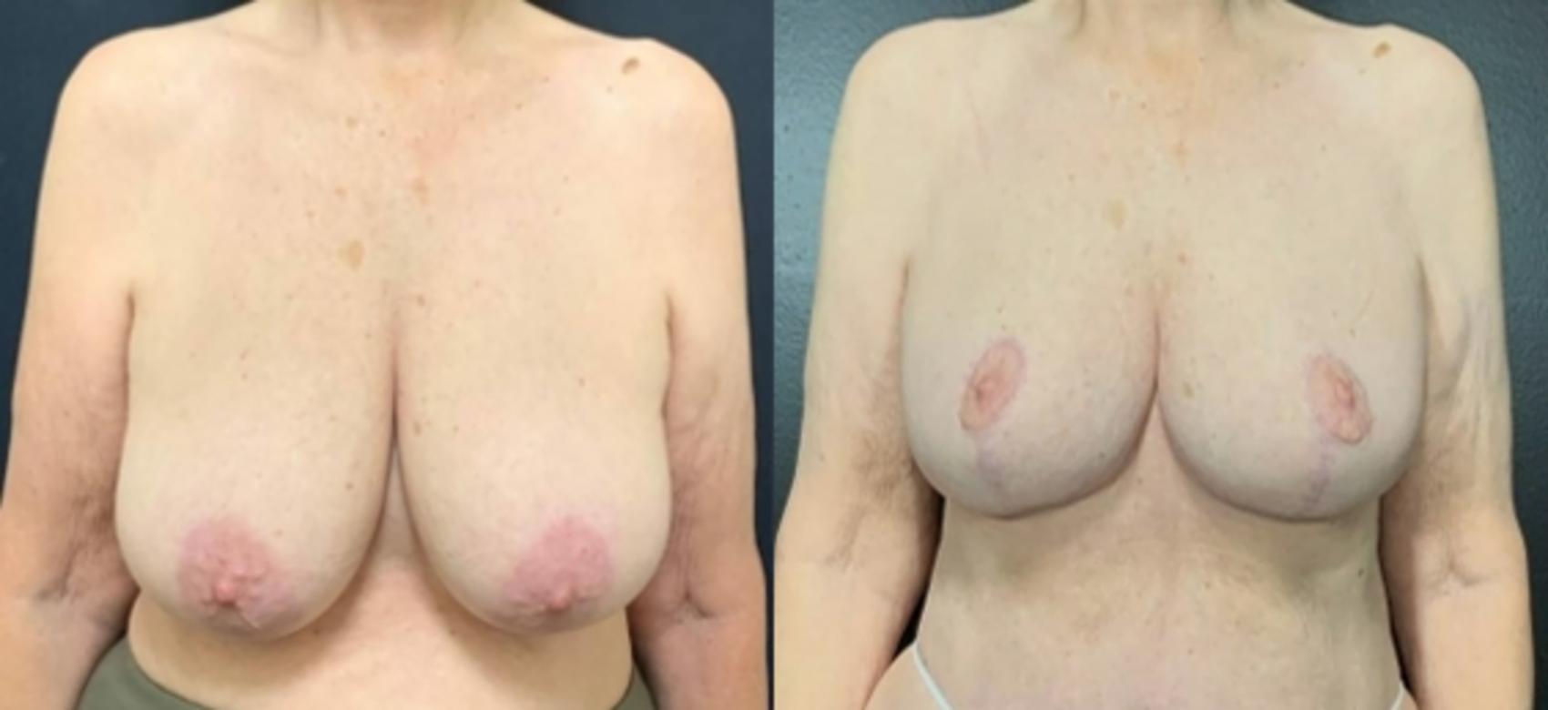 Breast Lift Before & After Photo | San Francisco, CA | Kaiser Permanente Cosmetic Services