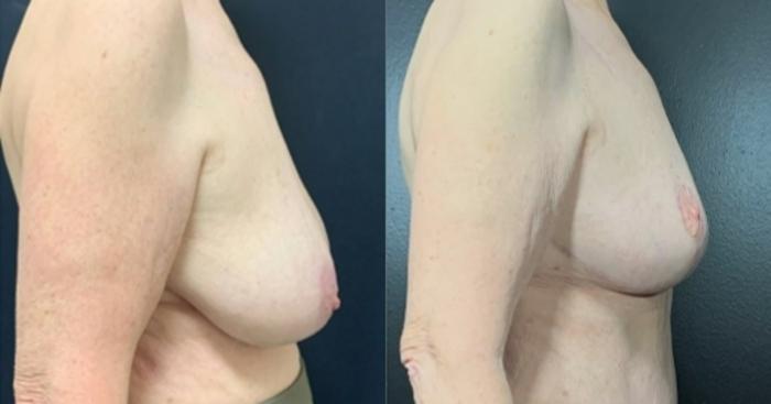 Breast Lift Before & After Photo | San Francisco, CA | Kaiser Permanente Cosmetic Services