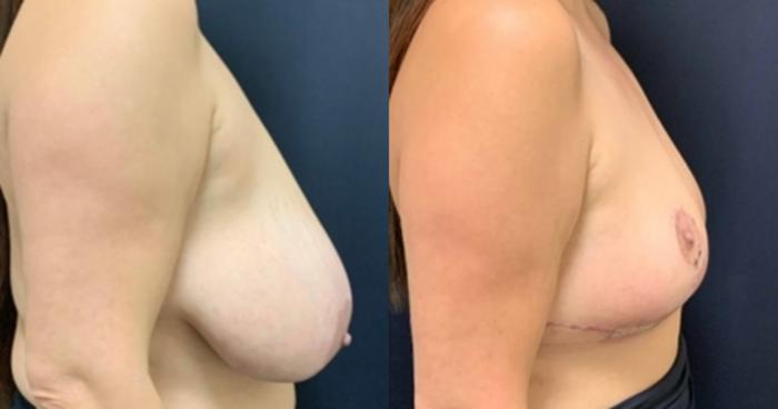 Breast Lift Before & After Photo | San Francisco, CA | Kaiser Permanente Cosmetic Services