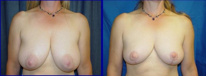 Breast Lift Before & After Photo | San Francisco, CA | Kaiser Permanente Cosmetic Services