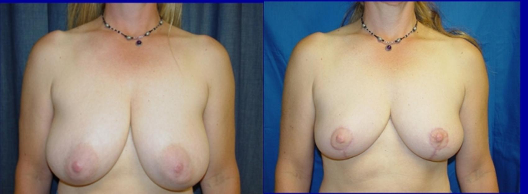 Breast Lift Before & After Photo | San Francisco, CA | Kaiser Permanente Cosmetic Services