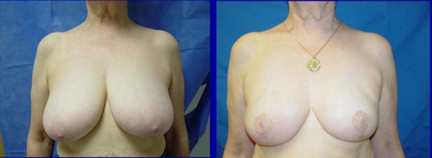 Breast Lift Before & After Photo | San Francisco, CA | Kaiser Permanente Cosmetic Services