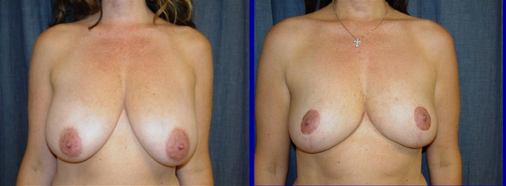 Breast Lift Before & After Photo | San Francisco, CA | Kaiser Permanente Cosmetic Services