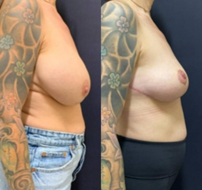 Breast Lift Before & After Photo | San Francisco, CA | Kaiser Permanente Cosmetic Services