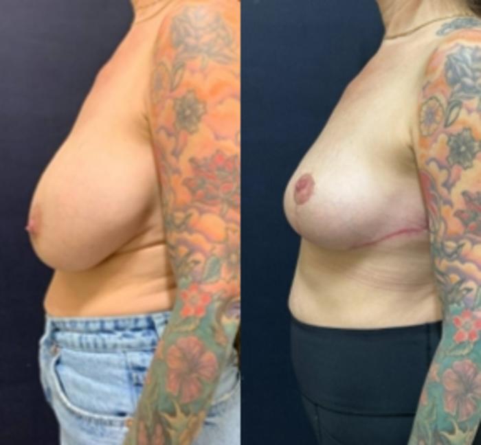 Breast Lift Before & After Photo | San Francisco, CA | Kaiser Permanente Cosmetic Services