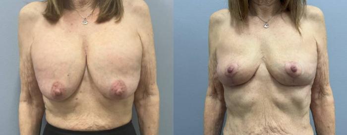 Breast explant with mastopexy.