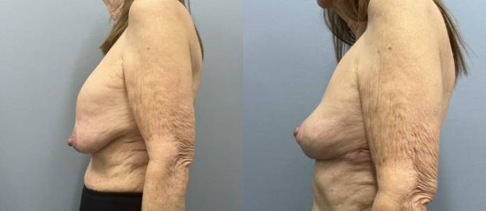 Breast Lift Before & After Photo | San Francisco, CA | Kaiser Permanente Cosmetic Services