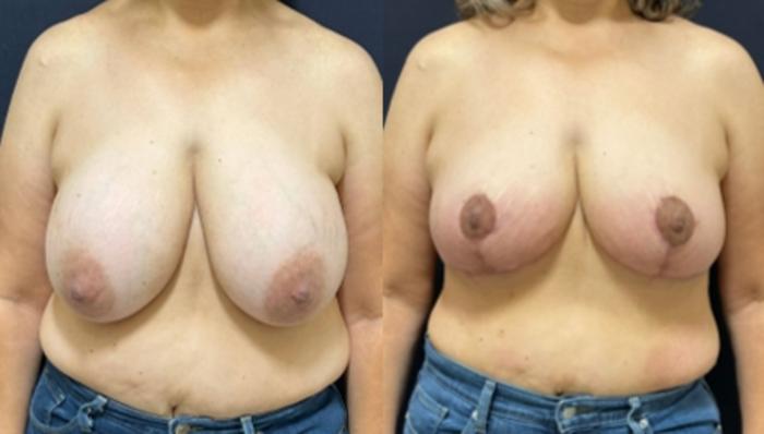 Breast Lift Before & After Photo | San Francisco, CA | Kaiser Permanente Cosmetic Services