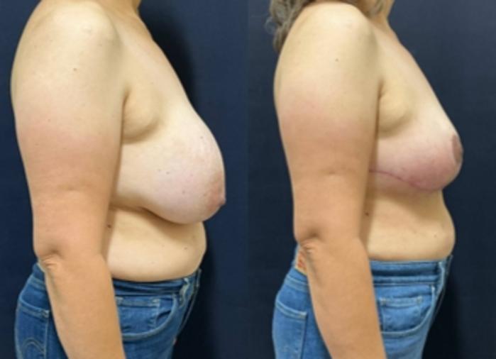 Breast Lift Before & After Photo | San Francisco, CA | Kaiser Permanente Cosmetic Services
