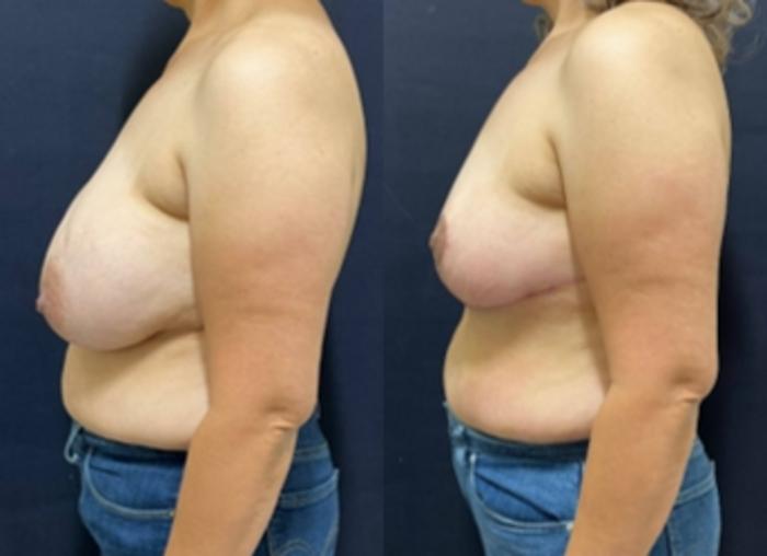 Breast Lift Before & After Photo | San Francisco, CA | Kaiser Permanente Cosmetic Services