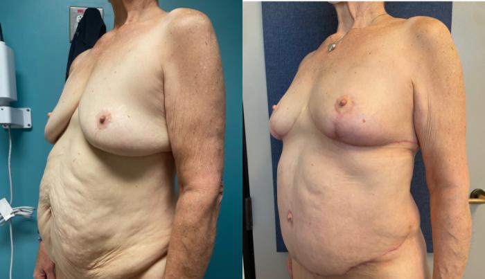 Breast Lift Before & After Photo | San Francisco, CA | Kaiser Permanente Cosmetic Services