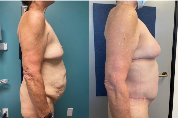 Breast Lift Before & After Photo | San Francisco, CA | Kaiser Permanente Cosmetic Services