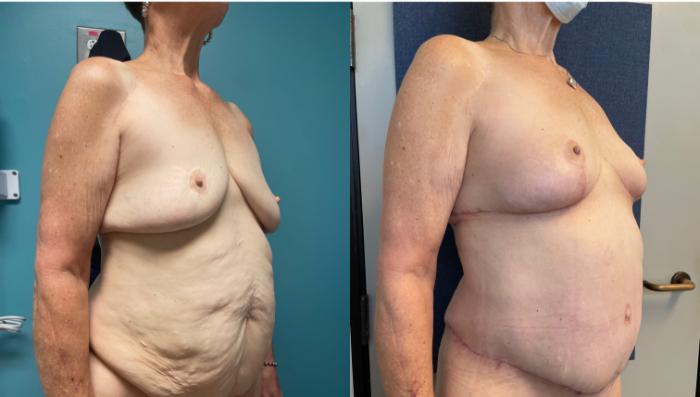 Breast Lift Before & After Photo | San Francisco, CA | Kaiser Permanente Cosmetic Services