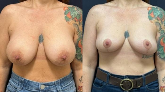Breast Lift Before & After Photo | San Francisco, CA | Kaiser Permanente Cosmetic Services