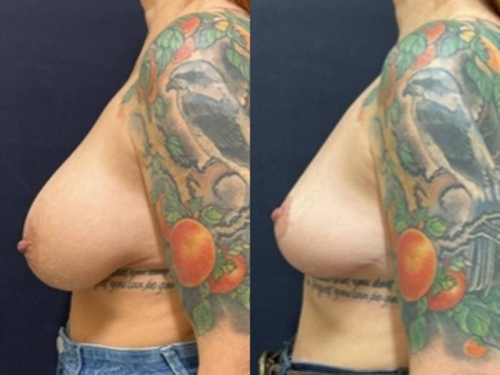 Breast Lift Before & After Photo | San Francisco, CA | Kaiser Permanente Cosmetic Services