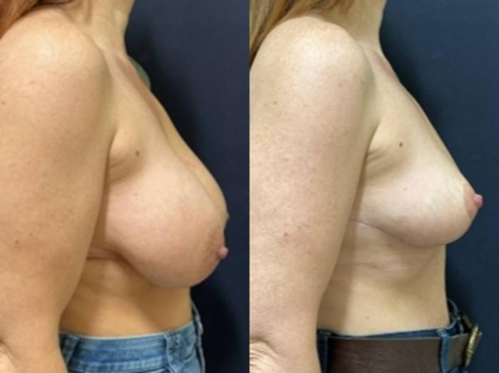 Breast Lift Before & After Photo | San Francisco, CA | Kaiser Permanente Cosmetic Services