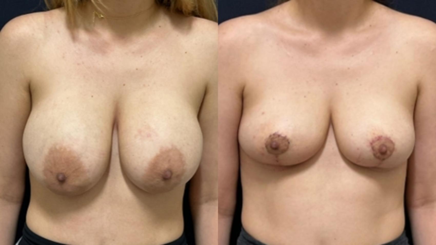 Breast Lift Before & After Photo | San Francisco, CA | Kaiser Permanente Cosmetic Services