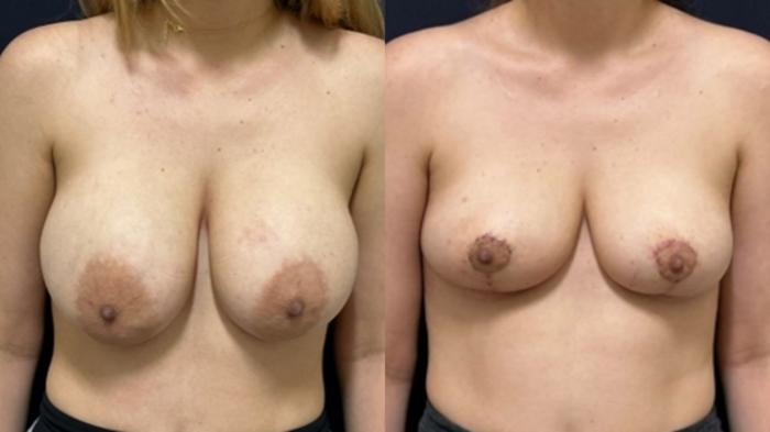 Breast Lift Before & After Photo | San Francisco, CA | Kaiser Permanente Cosmetic Services