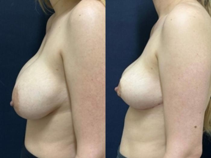 Breast Lift Before & After Photo | San Francisco, CA | Kaiser Permanente Cosmetic Services