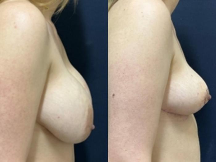 Breast Lift Before & After Photo | San Francisco, CA | Kaiser Permanente Cosmetic Services