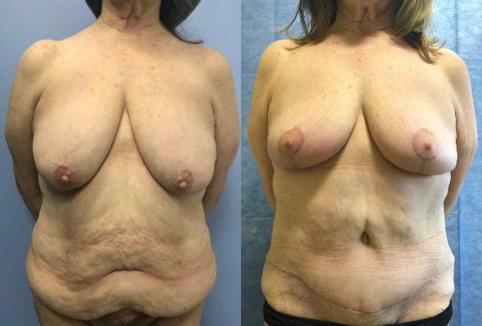 Breast Reduction Before & After Photo | San Francisco, CA | Kaiser Permanente Cosmetic Services