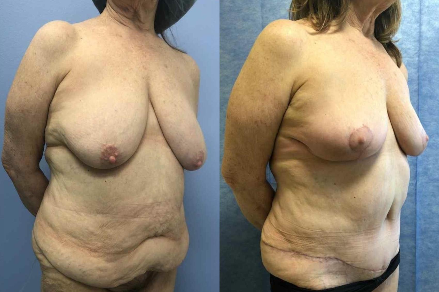 Breast Reduction Before & After Photo | San Francisco, CA | Kaiser Permanente Cosmetic Services
