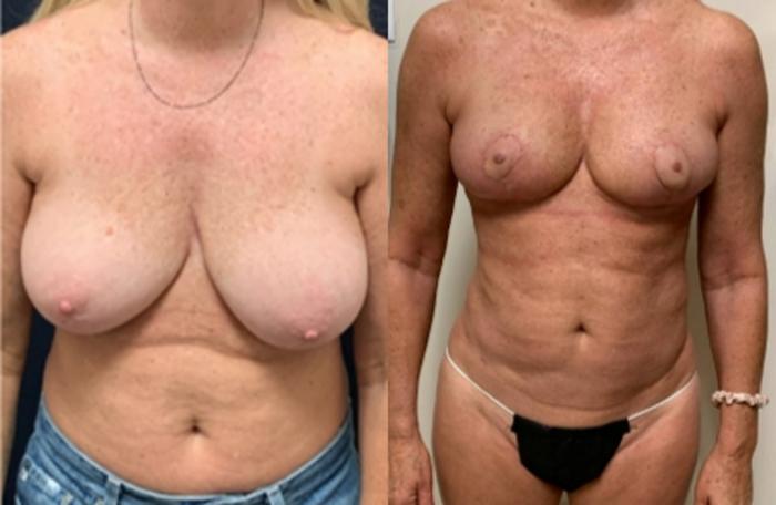 Breast Reduction Before & After Photo | San Francisco, CA | Kaiser Permanente Cosmetic Services