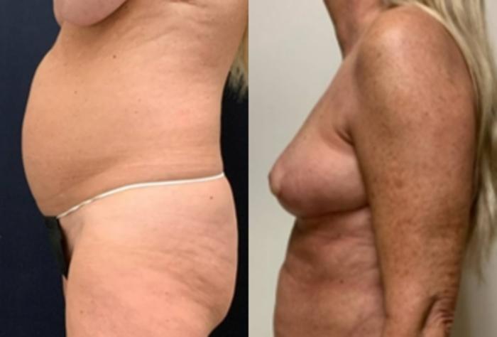 Breast Reduction Before & After Photo | San Francisco, CA | Kaiser Permanente Cosmetic Services