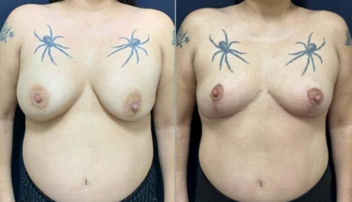 Breast Reduction Before & After Photo | San Francisco, CA | Kaiser Permanente Cosmetic Services