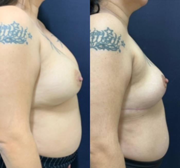 Breast Reduction Before & After Photo | San Francisco, CA | Kaiser Permanente Cosmetic Services
