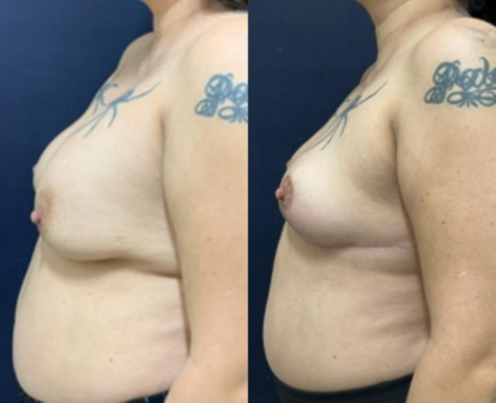 Breast Reduction Before & After Photo | San Francisco, CA | Kaiser Permanente Cosmetic Services