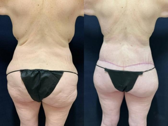 Breast Reduction Before & After Photo | San Francisco, CA | Kaiser Permanente Cosmetic Services