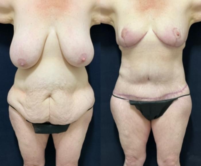 Breast Reduction Before & After Photo | San Francisco, CA | Kaiser Permanente Cosmetic Services