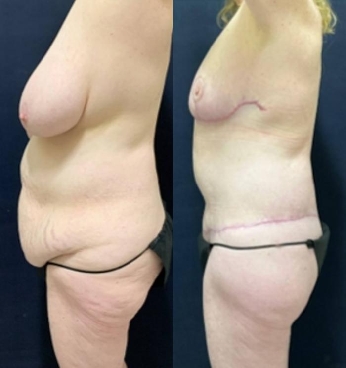 Breast Reduction Before & After Photo | San Francisco, CA | Kaiser Permanente Cosmetic Services
