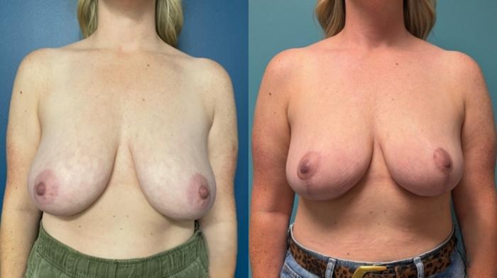 Breast Reduction Before & After Photo | San Francisco, CA | Kaiser Permanente Cosmetic Services